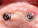 Behandlung einer Zahnfleischzezession am Implantat: Ergebnisse durch Mikrochirurgie