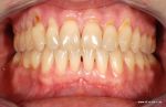 Multirezessionen Zahnfleischrückgang an vielen Zähnen
