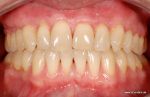 Multirezessionen Zahnfleischschwund Behandlung mit Eigengewebe und Amelogenin
