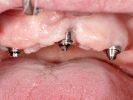 Zahnfleischschwund am Implantat bei einer festsitzenden implantatgetragenen Brücke
