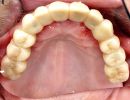feste Zähne sofort: Abbildung einer definitiven Versorgung nach Eingliederung