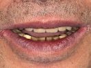 feste Zähne auf Sofortimplantaten