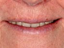 feste Zähne sofort im Oberkiefer oder Unterkiefer