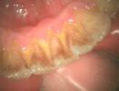 Zahnbeläge vor professioner Zahnreinigung