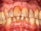 Zahnästhetik: Kronen tragen zum Ausgleich umfangreicher Zahnstellungs- und Farbanomalien bei
