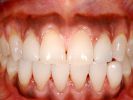 Einzelne Verblendschalen können ungünstige Zahnformen ausgleichen, ohne dass Kronen hergestellt werden müssen.