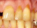 keilförmiger Defekt als Putzschaden im Zahnschmelz