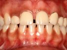 Ästhetik passiver Zahndurchbruch