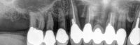 Weiterlesen: Parodontitis / Zahnfleischentzündungen
