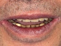 Weiterlesen: feste dritte Zähne an einem Tag
