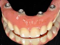 Weiterlesen: feste dritte Zähne an einem Tag