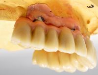 ein deutsches Meisterlabor macht es möglich: hohe Präzision von festen Zähnen auf nur vier Implantaten