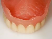 provisorische Prothese mit Gaumenplatte zur Ästhetik- und Funktionsanalyse