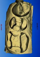 CEREC-Verfahren; Schritt 3: dreidimensionale intraorale Digitalisierung