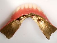 Unterkiefer Totalprothese auf 4 Implantaten (stable-base-Prinzip)